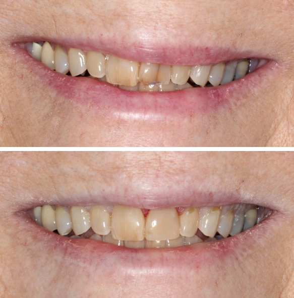 Close up of smile before and after dental treatment in Fort Mill