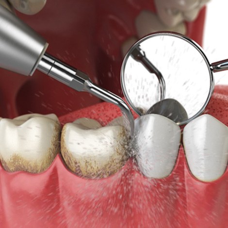 Illustration of dental tool removing plaque