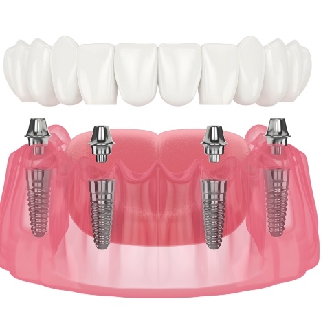 Animated four dental implants with full implant denture