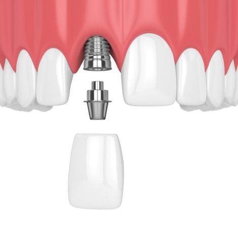 Animated dental implant with dental crown