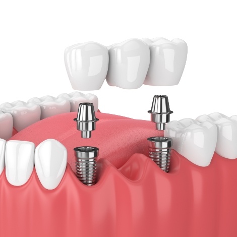 Animated two dental implants with dental bridge