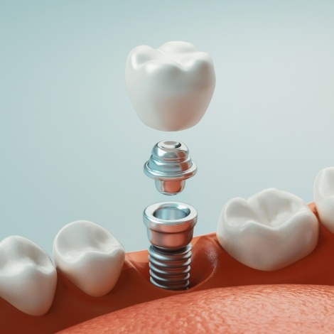 Animated dental implant with dental crown replacing a missing tooth