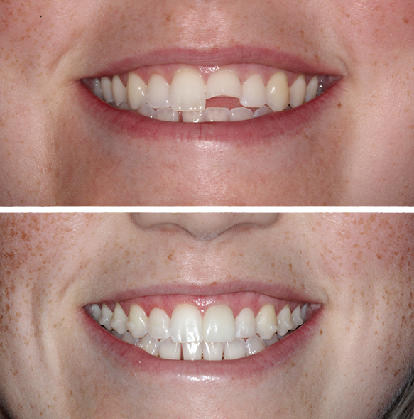 Close up of smile before and after correcting a chipped tooth