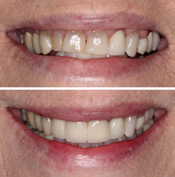 Close up of smile before and after fixing discolored teeth