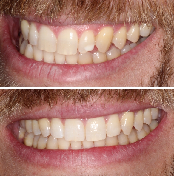 Close up of smile before and after fixing a chipped front tooth