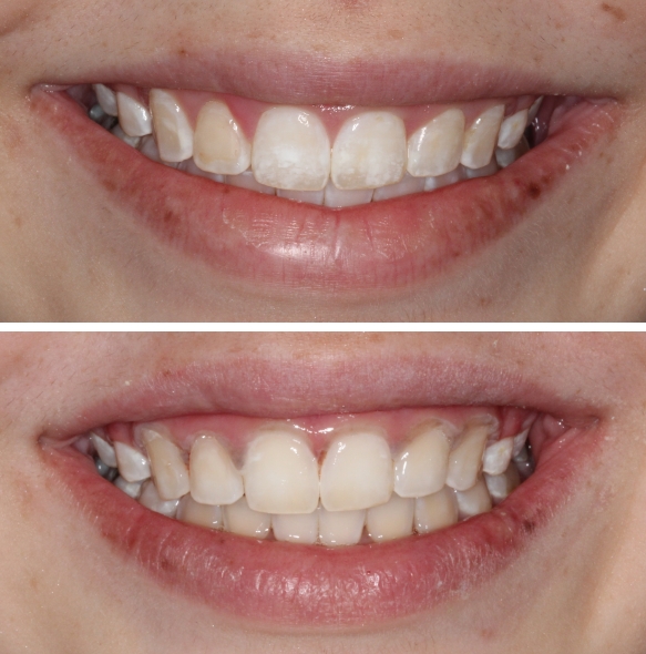 Close up of smile before and after teeth whitening