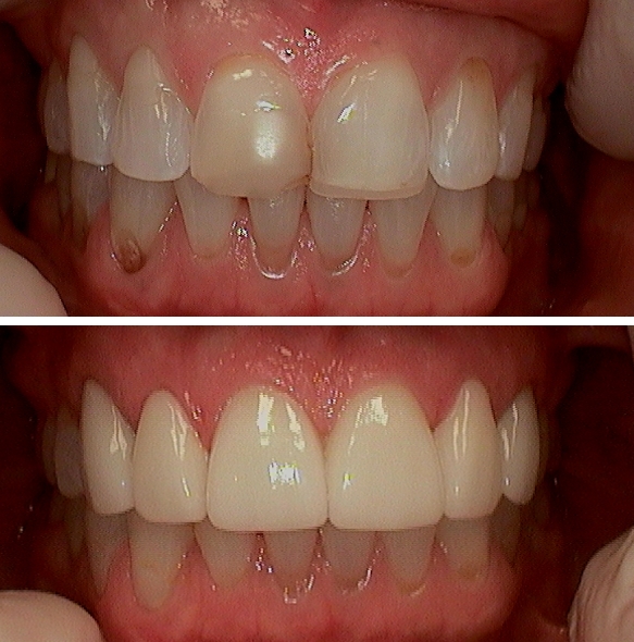 Close up of smile before and after fixing gum recession