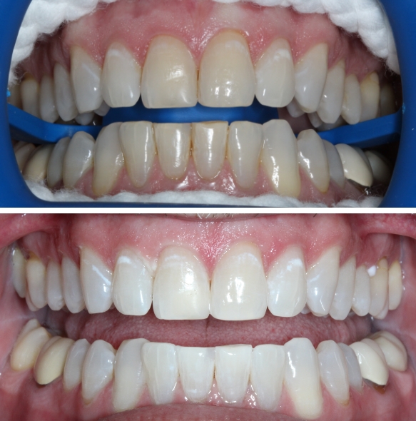 Close up of smile before and after correcting stained teeth