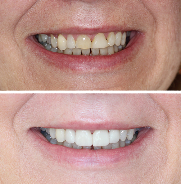 Close up of smile before and after brightening dull teeth