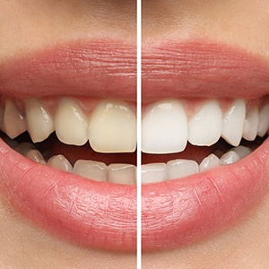 Before-and-after image of stained teeth