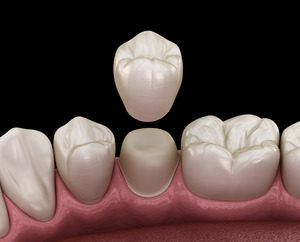 Crown made of tooth-colored material being placed