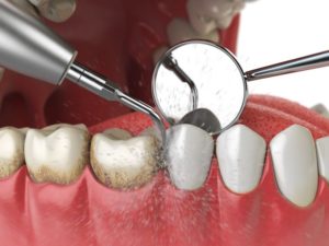 Illustration of ultrasonic cleaner removing tartar from teeth